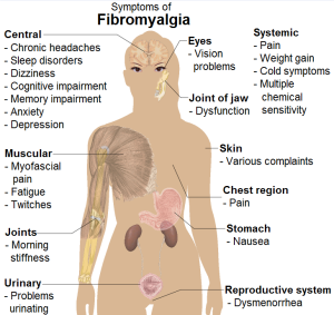 Symptoms of Fibromyalgia